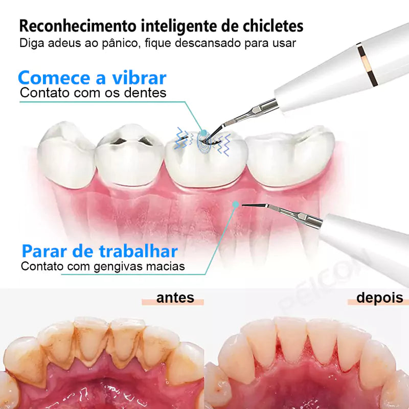 removedor-de-tartaro-ultrassonico-2