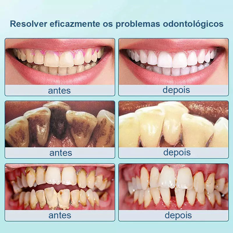 removedor-de-tartaro-ultrassonico-4